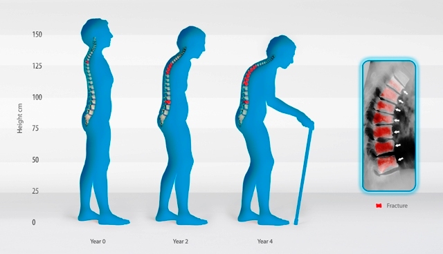 Osteoporosis